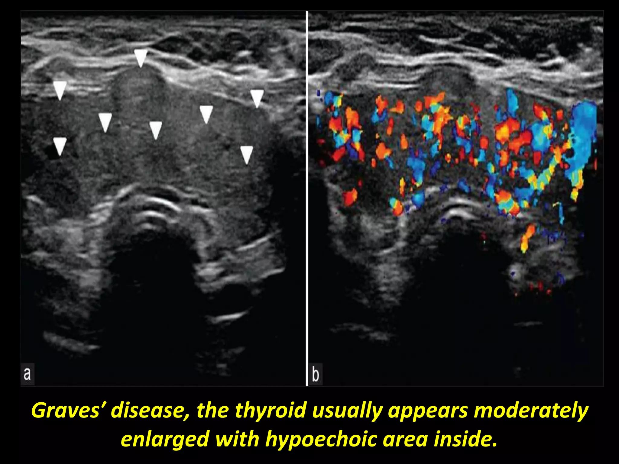 Presentation1.pptx, radiological imaging of the thyroid gland diseases ...