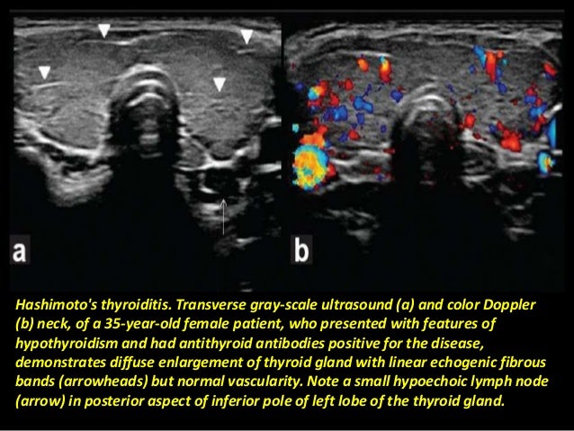 Presentation1 Pptx Radiological Imaging Of The Thyroid Gland Disease