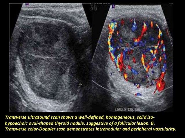 Papillary Thyroid Cancer Ultrasound Colors Warehouse Of Ideas Papillary Thyroid Cancer Ultrasound Colors Warehouse Of Ideas