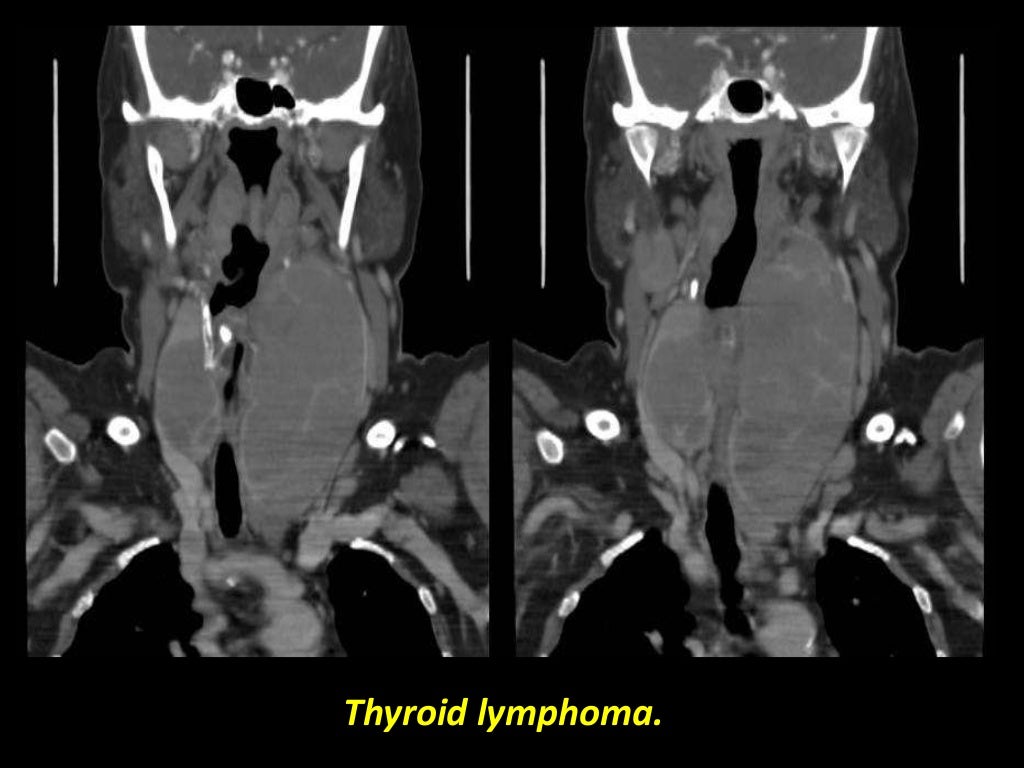 Presentation1.pptx, radiological imaging of the thyroid gland disease…