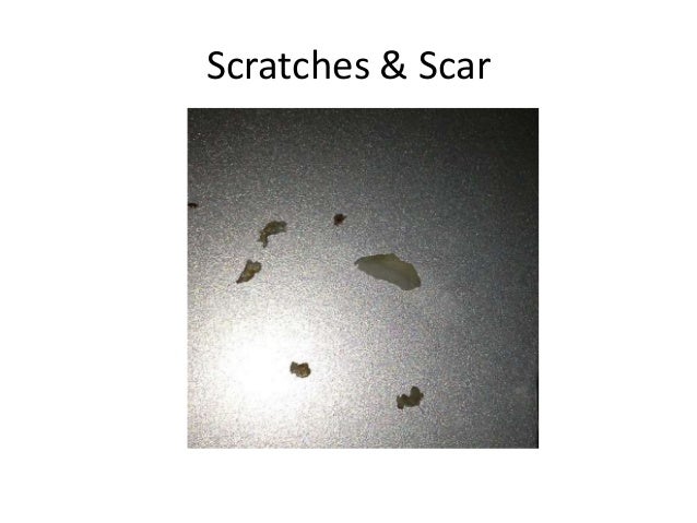 Acne vulgaris extraction videos image