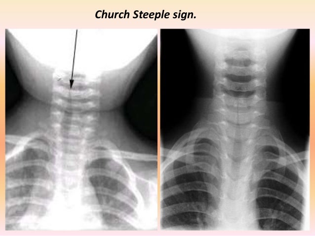 Which Condition Causes A Steeple Sign On X-ray? Presentation1.pptx, radiological imaging of the larngeal diseases.