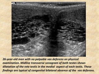 Vasogram Presentation1.pptx, radiological imaging of male infertility. | PPTX