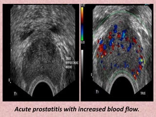 Acute prostatitis with increased blood flow.
 