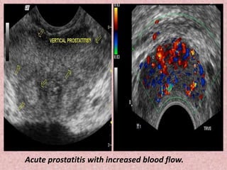 Acute prostatitis with increased blood flow.
 
