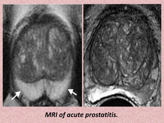 MRI of acute prostatitis.
 