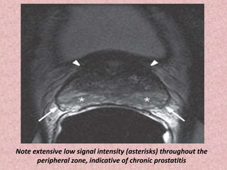 Note extensive low signal intensity (asterisks) throughout the
peripheral zone, indicative of chronic prostatitis
 
