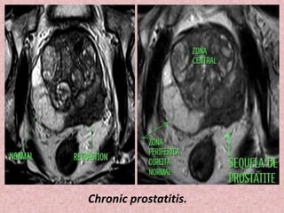 Chronic prostatitis.
 