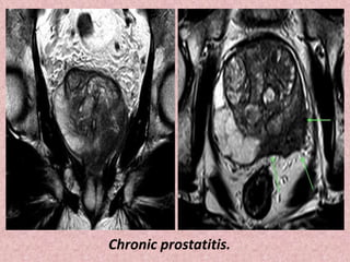 Chronic prostatitis.
 
