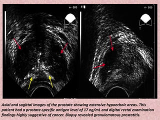 Axial and sagittal images of the prostate showing extensive hypoechoic areas. This
patient had a prostate-specific antigen level of 17 ng/mL and digital rectal examination
findings highly suggestive of cancer. Biopsy revealed granulomatous prostatitis.
 
