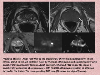 Prostatic abscess - Axial T2W MRI of the prostate (A) shows high signal (arrow) in the
central gland, in the left midzone. Axial T1W image (B) shows mixed signal intensity with
peripheral hyperintensity (arrow). Axial, contrast-enhanced T1W image (C) shows a
peripherally enhancing abscess (arrow). DWI (b=800) (D) shows restriction of diffusion
(arrow) in the lesion. The corresponding ADC map (E) shows low signal (arrow).
 