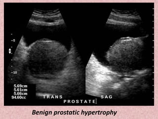 Benign prostatic hypertrophy
 