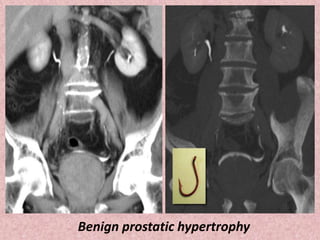 Benign prostatic hypertrophy
 