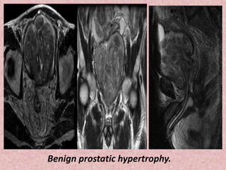 Benign prostatic hypertrophy.
 