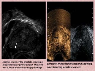 Sagittal image of the prostate showing a
hypoechoic area (white arrow). This area
was a focus of cancer on biopsy findings
Contrast-enhanced ultrasound showing
an enhancing prostate cancer.
 