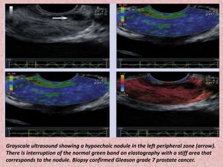 Grayscale ultrasound showing a hypoechoic nodule in the left peripheral zone (arrow).
There is interruption of the normal green band on elastography with a stiff area that
corresponds to the nodule. Biopsy confirmed Gleason grade 7 prostate cancer.
 