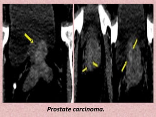 Prostate carcinoma.
 