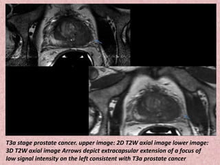 T3a stage prostate cancer. upper image: 2D T2W axial image lower image:
3D T2W axial image Arrows depict extracapsular extension of a focus of
low signal intensity on the left consistent with T3a prostate cancer
 