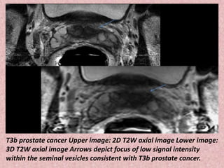 T3b prostate cancer Upper image: 2D T2W axial image Lower image:
3D T2W axial image Arrows depict focus of low signal intensity
within the seminal vesicles consistent with T3b prostate cancer.
 