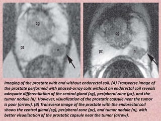 Imaging of the prostate with and without endorectal coil. (A) Transverse image of
the prostate performed with phased-array coils without an endorectal coil reveals
adequate differentiation of the central gland (cg), peripheral zone (pz), and the
tumor nodule (n). However, visualization of the prostatic capsule near the tumor
is poor (arrow). (B) Transverse image of the prostate with the endorectal coil
shows the central gland (cg), peripheral zone (pz), and tumor nodule (n), with
better visualization of the prostatic capsule near the tumor (arrow).
 