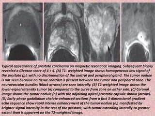 Typical appearance of prostate carcinoma on magnetic resonance imaging. Subsequent biopsy
revealed a Gleason score of 4 + 4. (A) T1- weighted image shows homogeneous low signal of
the prostate (p), with no discrimination of the central and peripheral gland. The tumor nodule
is not seen because no tissue contrast is present between the tumor and peripheral zone. The
neurovascular bundles (black arrows) are seen laterally. (B) T2-weighted image shows the
lower-signal intensity tumor (n) compared to the curve from zone on either side. (C) Coronal
image shows the tumor nodule (n) with the adjoining apical prostatic capsule shown (arrow).
(D) Early-phase gadolinium chelate-enhanced sections from a fast 3-dimensional gradient
echo sequence show rapid intense enhancement of the tumor nodule (n), manifested by
brighter signal intensity in the rest of the prostate, with tumor extending laterally to greater
extent than is apparent on the T2-weighted image.
 