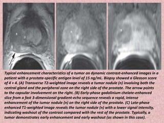 Typical enhancement characteristics of a tumor on dynamic contrast-enhanced images in a
patient with a prostate-specific antigen level of 15 ng/mL. Biopsy showed a Gleason score
of 4 + 4. (A) Transverse T2-weighted image reveals a tumor nodule (n) involving both the
central gland and the peripheral zone on the right side of the prostate. The arrow points
to the capsular involvement on the right. (B) Early-phase gadolinium chelate-enhanced
slice from a fast 3-dimensional gradient-echo sequence reveals a rapid, intense
enhancement of the tumor nodule (n) on the right side of the prostate. (C) Late-phase
enhanced T1-weighted image reveals the tumor nodule (n) with a lower signal intensity,
indicating washout of the contrast compared with the rest of the prostate. Typically, a
tumor demonstrates early enhancement and early washout (as shown in this case).
 