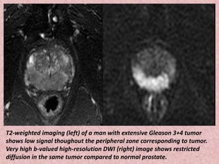 T2-weighted imaging (left) of a man with extensive Gleason 3+4 tumor
shows low signal thoughout the peripheral zone corresponding to tumor.
Very high b-valued high-resolution DWI (right) image shows restricted
diffusion in the same tumor compared to normal prostate.
 