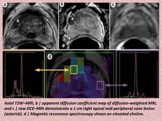Axial T2W–MRI, b | apparent diffusion coefficient map of diffusion-weighted MRI,
and c | raw DCE–MRI demonstrate a 1 cm right apical mid-peripheral zone lesion
(asterisk). d | Magnetic resonance spectroscopy shows an elevated choline.
 