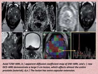 Axial T2W–MRI, b | apparent diffusion coefficient map of DW–MRI, and c | raw
DCE–MRI demonstrate a large 5 cm lesion, which affects almost the entire
prostate (asterisk). d,e | The lesion has extra capsular extension.
 