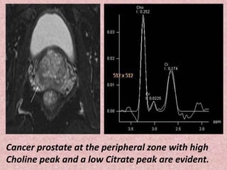 Cancer prostate at the peripheral zone with high
Choline peak and a low Citrate peak are evident.
 