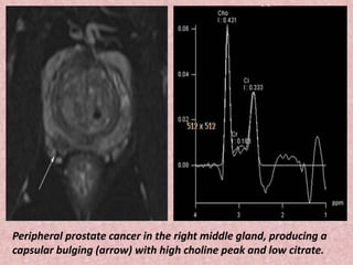 Peripheral prostate cancer in the right middle gland, producing a
capsular bulging (arrow) with high choline peak and low citrate.
 