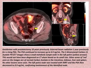 Gentleman with prostatectomy 10 years previously. External beam radiation 1 year previously
for a rising PSA. The PSA continued to increase up to 6.9 ng/mL. The 3 dimensional Carbon-11
Acetate PET/CT images show a small metabolic lymph node in the left pelvis (yellow arrows).
This would not have been diagnosed on CT alone based on its small size. Other areas of ‘red’
seen on the images are of normal Carbon Acetate in the intestines, kidneys, liver and spleen.
No other lesions were seen. The left pelvis node was treated with IMRT and the PSA then
decreased to 0.9 ng/mL, confirming involvement of the identified node.
 