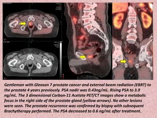 Gentleman with Gleason 7 prostate cancer and external beam radiation (EBRT) to
the prostate 4 years previously. PSA nadir was 0.43ng/mL. Rising PSA to 3.9
ng/mL. The 3 dimensional Carbon-11 Acetate PET/CT images show a metabolic
focus in the right side of the prostate gland (yellow arrows). No other lesions
were seen. The prostate recurrence was confirmed by biopsy with subsequent
Brachytherapy performed. The PSA decreased to 0.6 ng/mL after treatment.
 