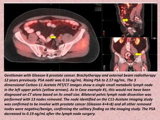 Gentleman with Gleason 6 prostate cancer. Brachytherapy and external beam radiotherapy
12 years previously. PSA nadir was 0.16 ng/mL. Rising PSA to 2.17 ng/mL. The 3
dimensional Carbon-11 Acetate PET/CT images show a single small metabolic lymph node
in the left upper pelvis (yellow arrows). As in Case example #1, this would not have been
diagnosed on CT alone based on its small size. Bilateral pelvic lymph node dissection was
performed with 13 nodes removed. The node identified on the C11-Acetate imaging study
was confirmed to be involve with prostate cancer (Gleason 4+4=8) and all other removed
nodes were negative/benign, confirming the solitary finding on the imaging study. The PSA
decreased to 0.19 ng/mL after the lymph node surgery.
 
