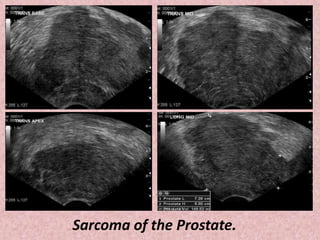 Sarcoma of the Prostate.
 