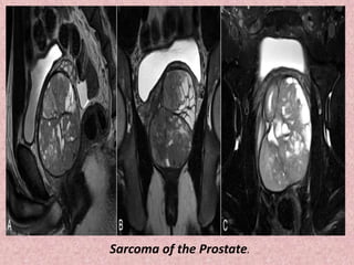 Sarcoma of the Prostate.
 