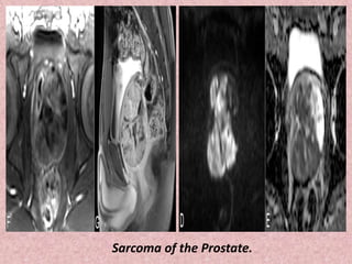 Sarcoma of the Prostate.
 