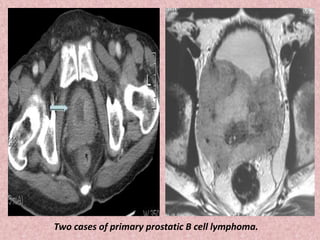 Two cases of primary prostatic B cell lymphoma.
 