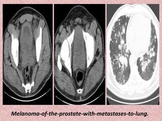 Melanoma-of-the-prostate-with-metastases-to-lung.
 