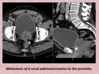 Metastasis of a cecal adenocarcinoma to the prostate.
 