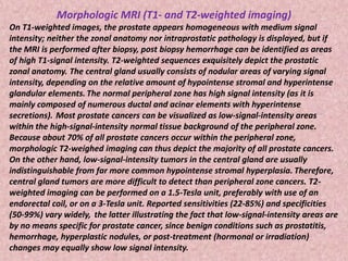 Morphologic MRI (T1- and T2-weighted imaging)
On T1-weighted images, the prostate appears homogeneous with medium signal
intensity; neither the zonal anatomy nor intraprostatic pathology is displayed, but if
the MRI is performed after biopsy, post biopsy hemorrhage can be identified as areas
of high T1-signal intensity. T2-weighted sequences exquisitely depict the prostatic
zonal anatomy. The central gland usually consists of nodular areas of varying signal
intensity, depending on the relative amount of hypointense stromal and hyperintense
glandular elements. The normal peripheral zone has high signal intensity (as it is
mainly composed of numerous ductal and acinar elements with hyperintense
secretions). Most prostate cancers can be visualized as low-signal-intensity areas
within the high-signal-intensity normal tissue background of the peripheral zone.
Because about 70% of all prostate cancers occur within the peripheral zone,
morphologic T2-weighed imaging can thus depict the majority of all prostate cancers.
On the other hand, low-signal-intensity tumors in the central gland are usually
indistinguishable from far more common hypointense stromal hyperplasia. Therefore,
central gland tumors are more difficult to detect than peripheral zone cancers. T2-
weighted imaging can be performed on a 1.5-Tesla unit, preferably with use of an
endorectal coil, or on a 3-Tesla unit. Reported sensitivities (22-85%) and specificities
(50-99%) vary widely, the latter illustrating the fact that low-signal-intensity areas are
by no means specific for prostate cancer, since benign conditions such as prostatitis,
hemorrhage, hyperplastic nodules, or post-treatment (hormonal or irradiation)
changes may equally show low signal intensity.
 