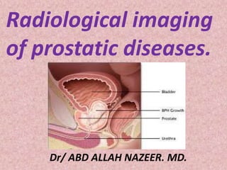 Radiological imaging
of prostatic diseases.
Dr/ ABD ALLAH NAZEER. MD.
 