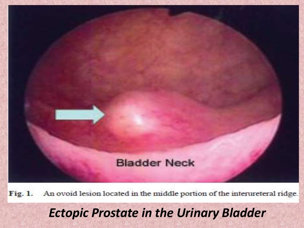 Presentation1.pptx, radiological imaging of prostatic diseases