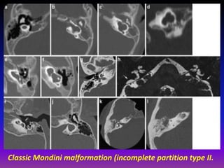 Presentation1.pptx, radiological imaging of inner ear diseases | PPTX