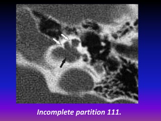 Presentation1.pptx, radiological imaging of inner ear diseases | PPTX