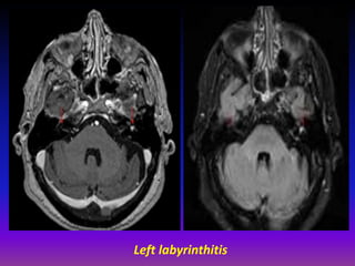 Labyrinthitis Radiopaedia Presentation1.pptx, radiological imaging of inner ear diseases | PPTX