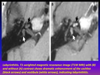 Labyrinthitis Radiopaedia Presentation1.pptx, radiological imaging of inner ear diseases | PPTX