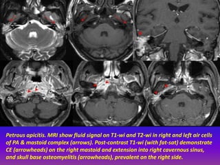 Presentation1.pptx, radiological imaging of inner ear diseases | PPTX
