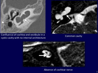 Presentation1.pptx, radiological imaging of inner ear diseases