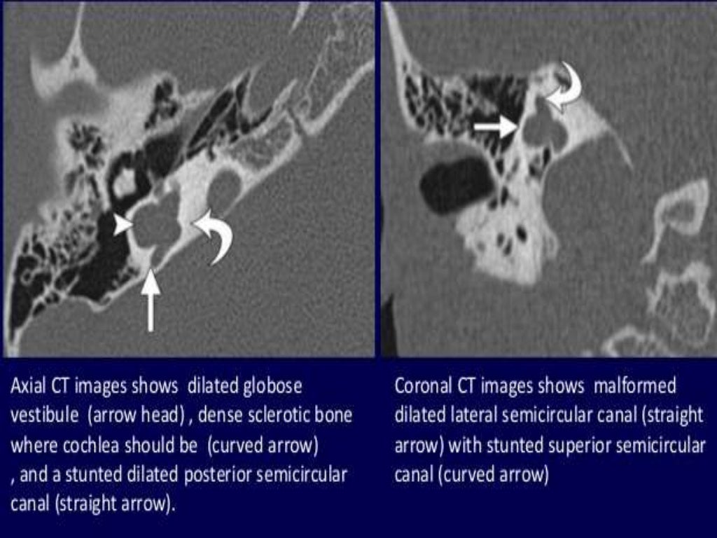 Presentation1.pptx, radiological imaging of inner ear diseases
